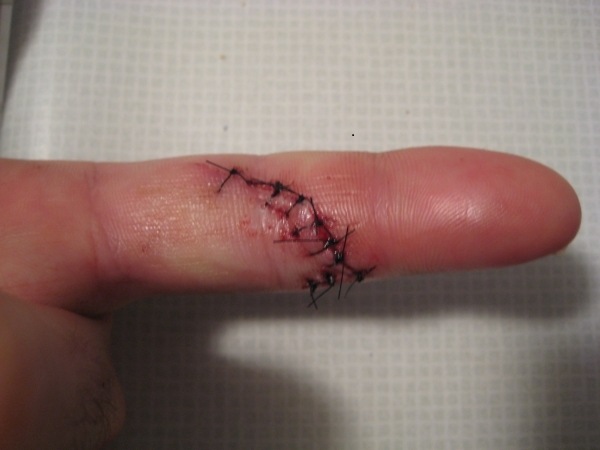 cut-left-index-finger-9-stitches.jpg