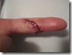 Cut Left Index Finger - 9 stitches